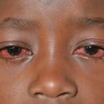 Yobe Residents Raise Alarm as Apollo Cases Spread in Potiskum