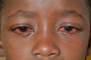 Yobe Residents Raise Alarm as Apollo Cases Spread in Potiskum